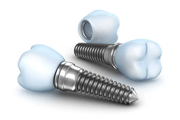 implantes-dentales-clinica-dental-bucodent-gijon