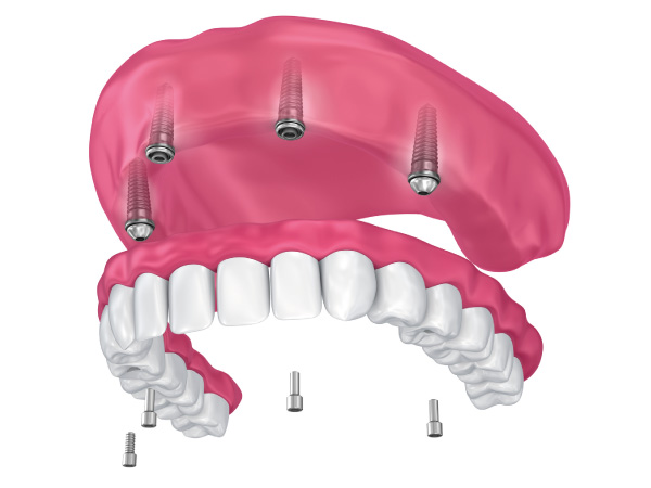 implantes dentales en Gijón prótesis híbrida