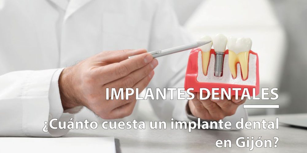 cuánto cuesta un implante dental en Gijón