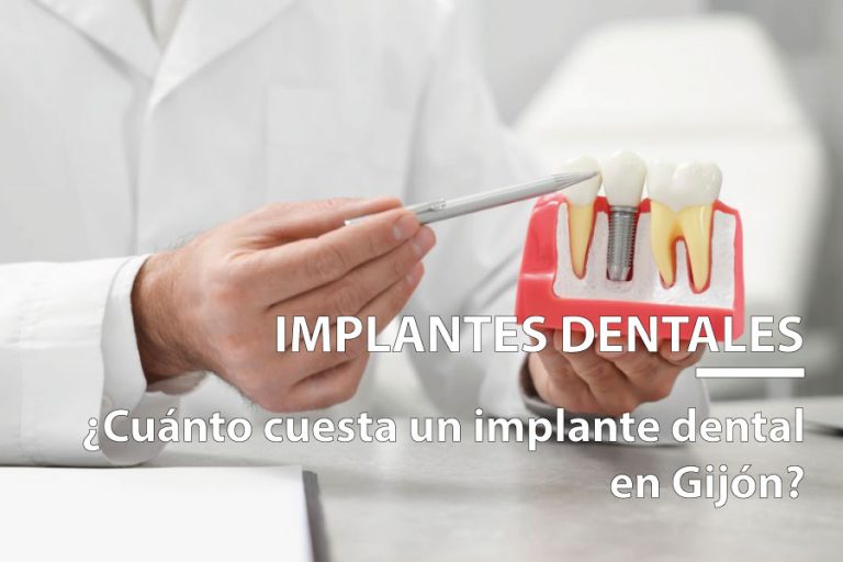 cuánto cuesta un implante dental en Gijón